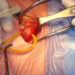 hernia surgery in vikaspuri delhi