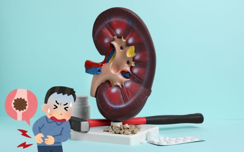 Renal concretion and its treatment | Best Kidney hospital in Delhi