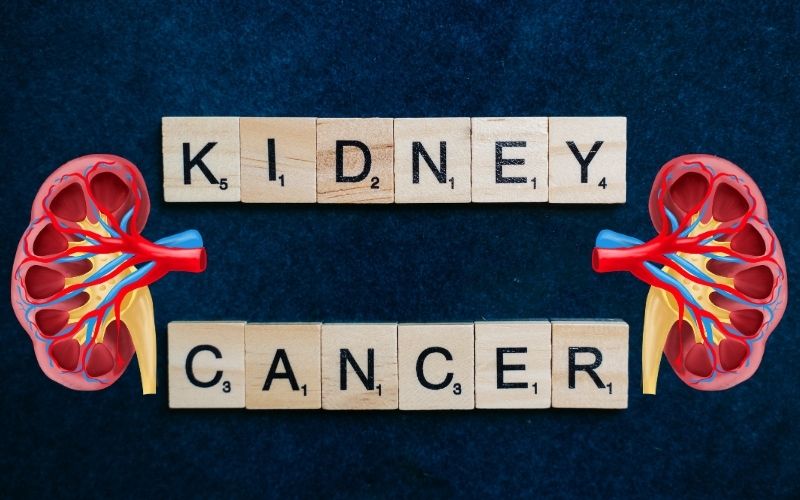 What is Renal Cell Carcinoma or Renal Cancer Treatment in Delhi
