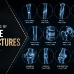 All types of bone fractures and fracture treatment in Delhi